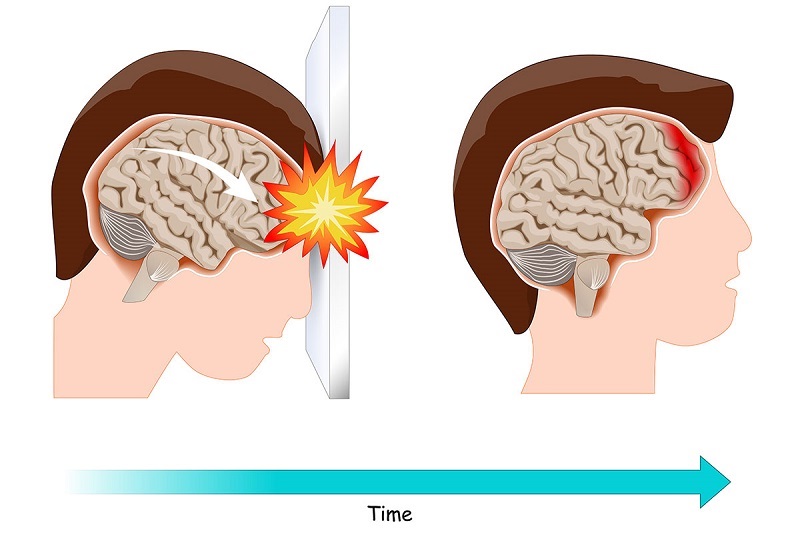 brain damage